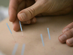Acupuncture - Health Care In Taiwan